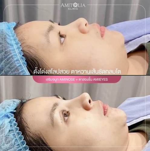 Review เสริมจมูก #78