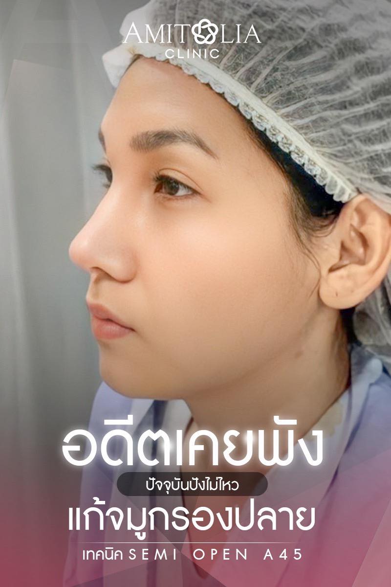 Review แก้จมูก #112