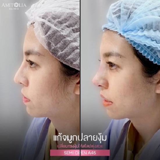 Review เสริมจมูก #118