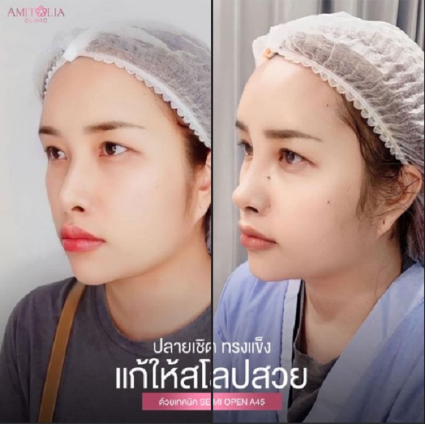 Review แก้จมูก #125