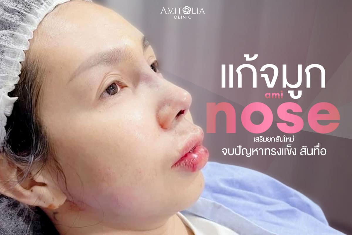 Review แก้จมูก #129