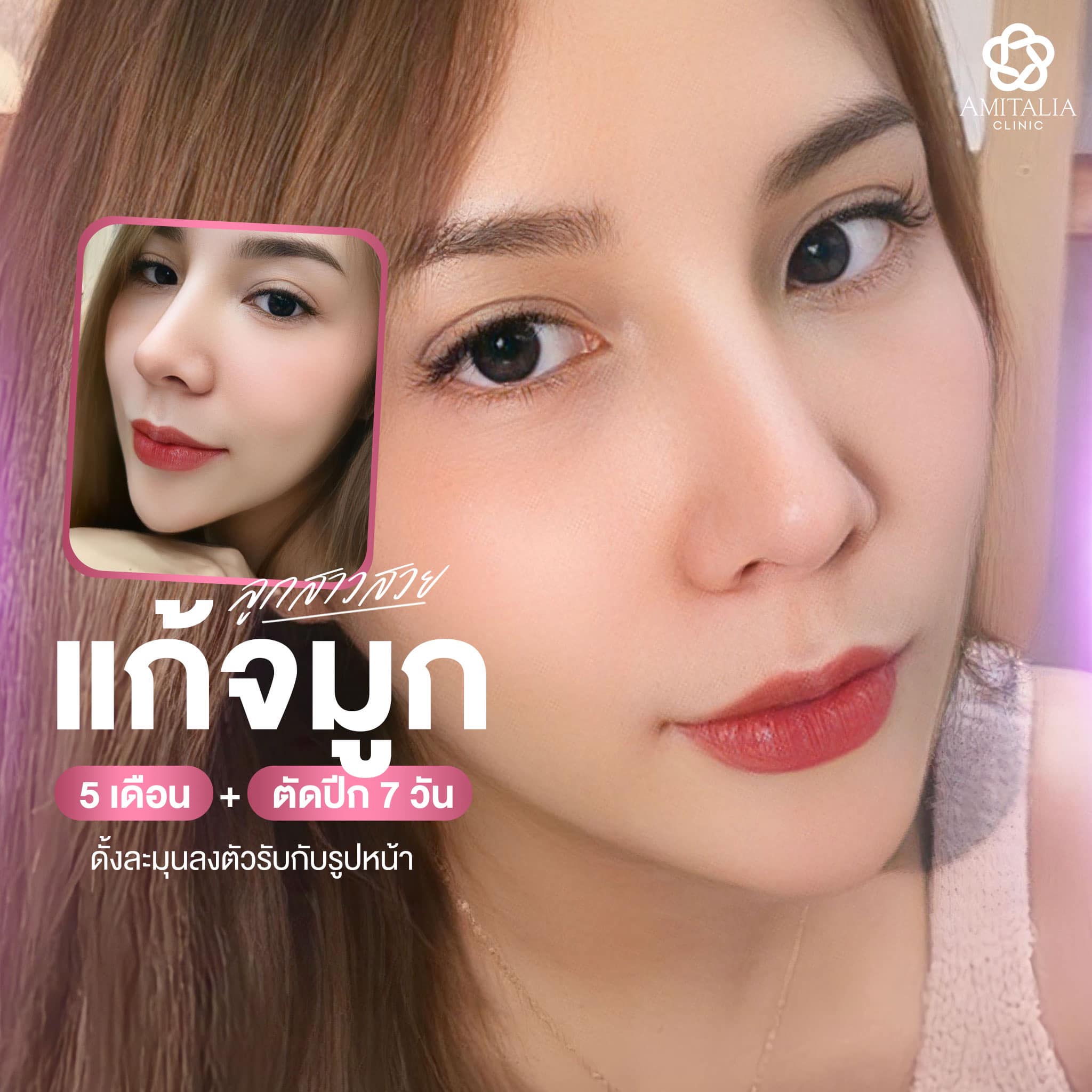 Review แก้จมูก #135