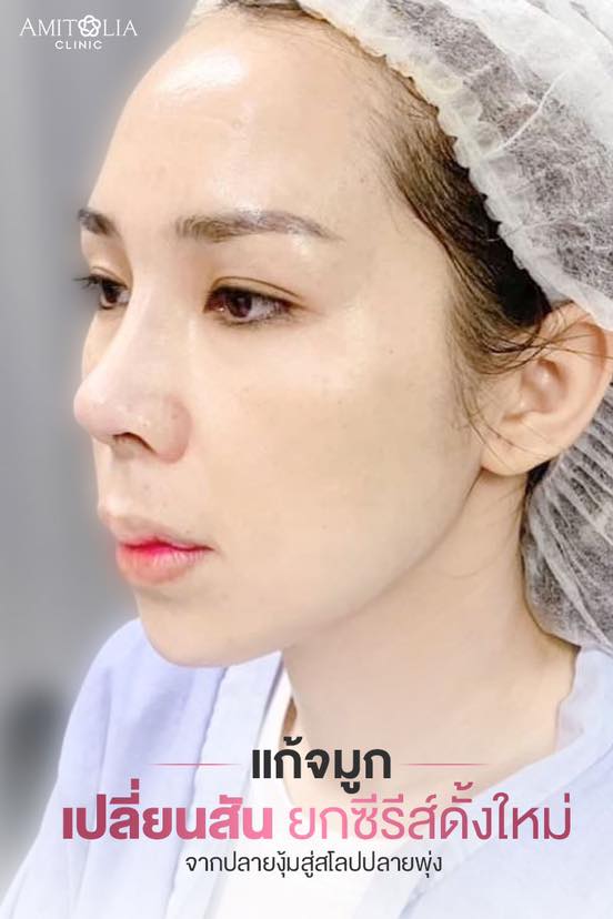 Review แก้จมูก #136