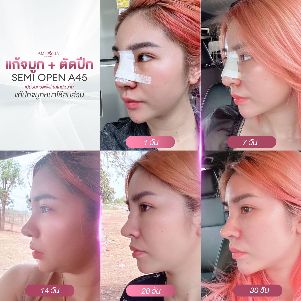 Review แก้จมูก #150
