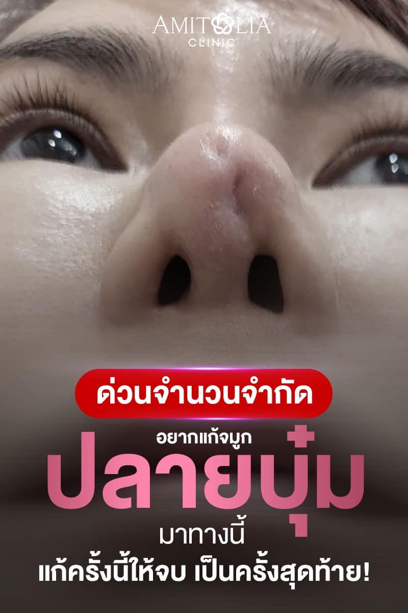 Review แก้จมูก #153