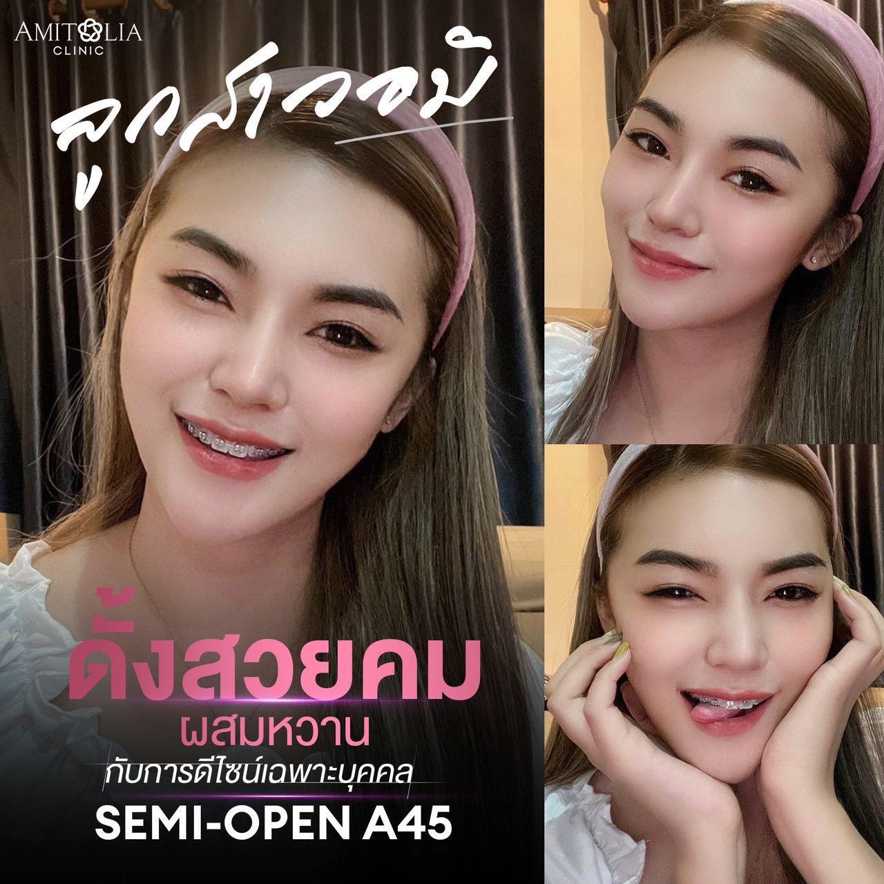 Review แก้จมูก #82