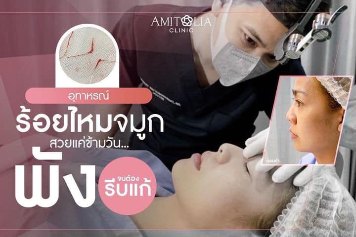 Review แก้จมูก #83