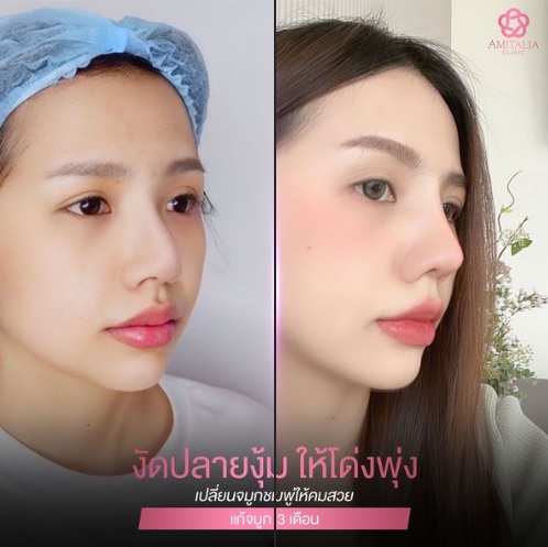 Review แก้จมูก #89