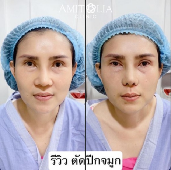 Review ตัดปีกจมูก #168
