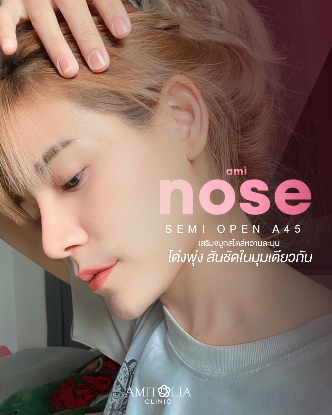 Review เสริมจมูก #169