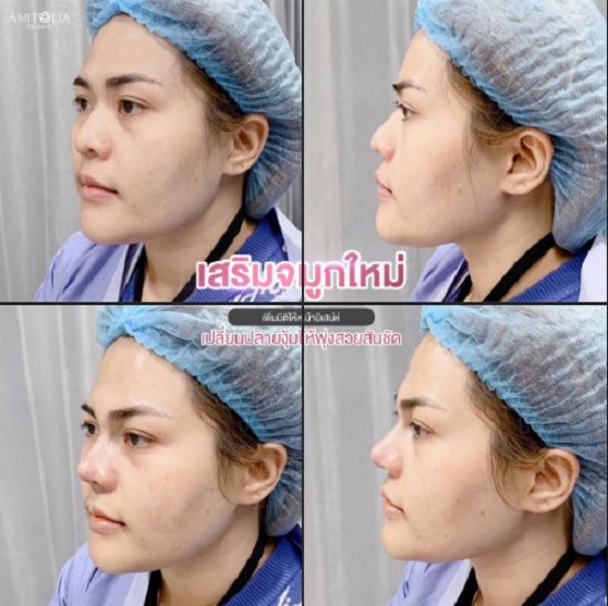 Review เสริมจมูก #175