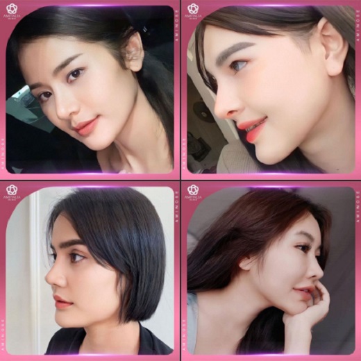 Review เสริมจมูก #178