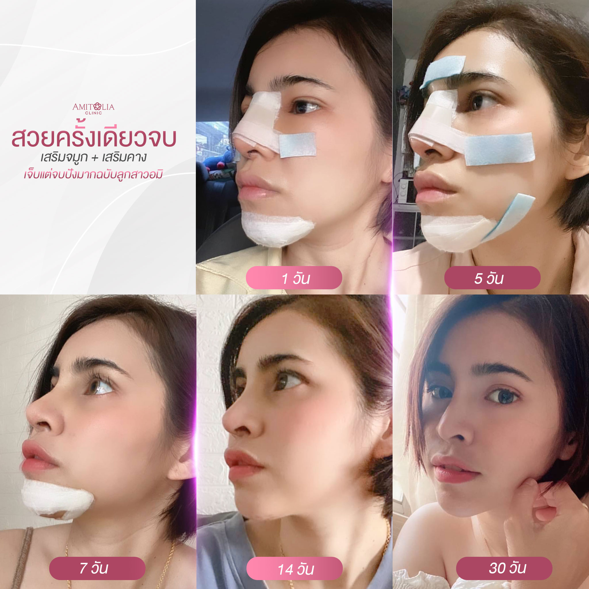 Review เสริมจมูก #170