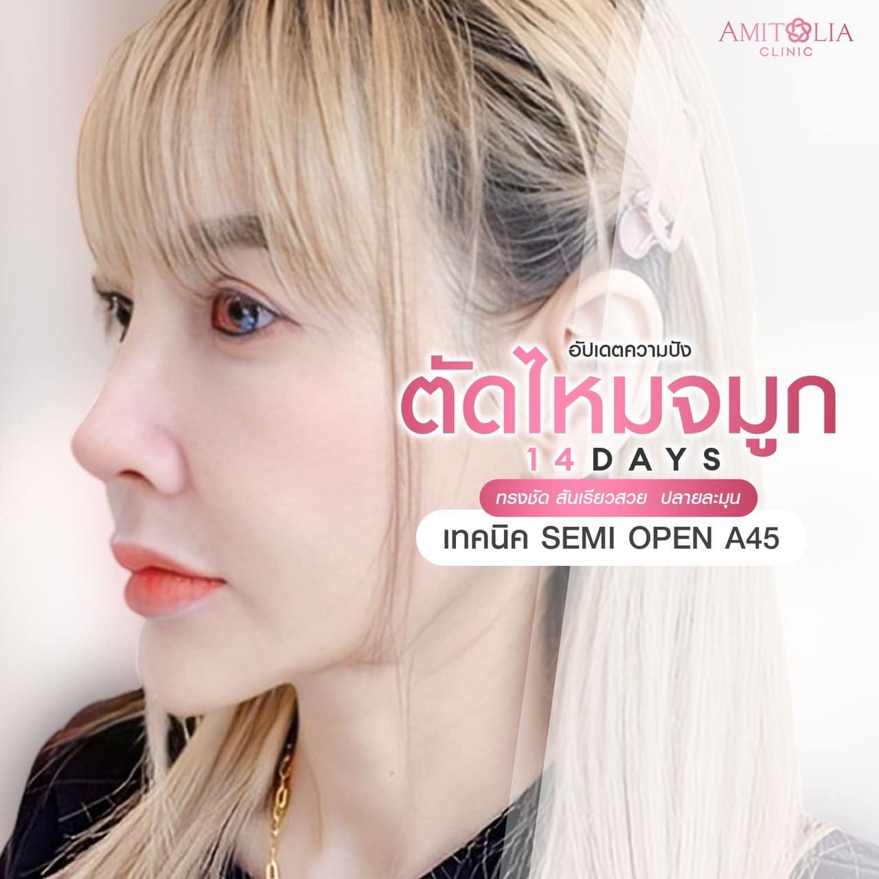 Review แก้จมูก #195