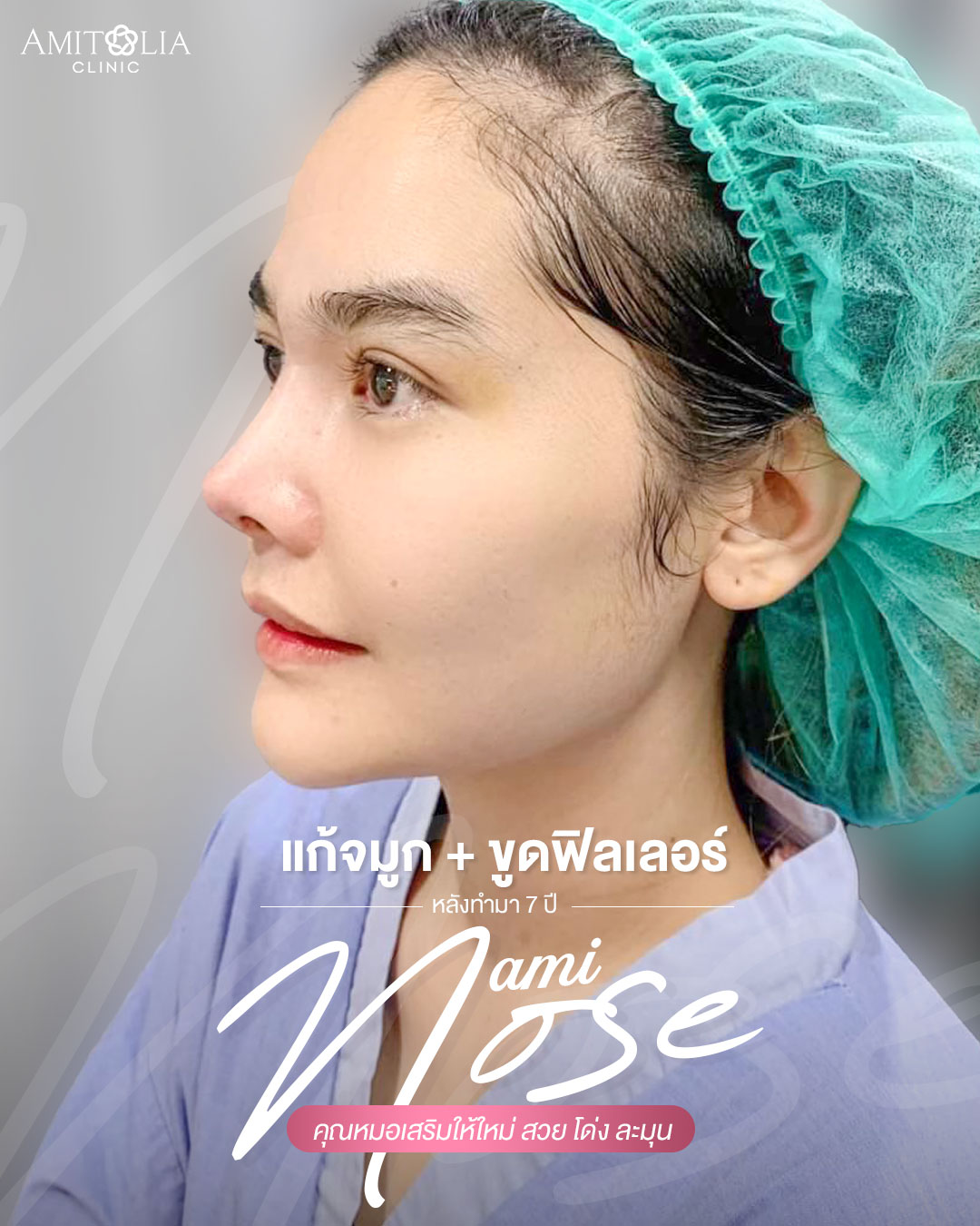 Review แก้จมูก #199