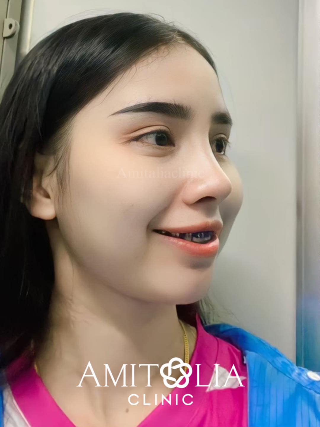 Review แก้จมูก #204