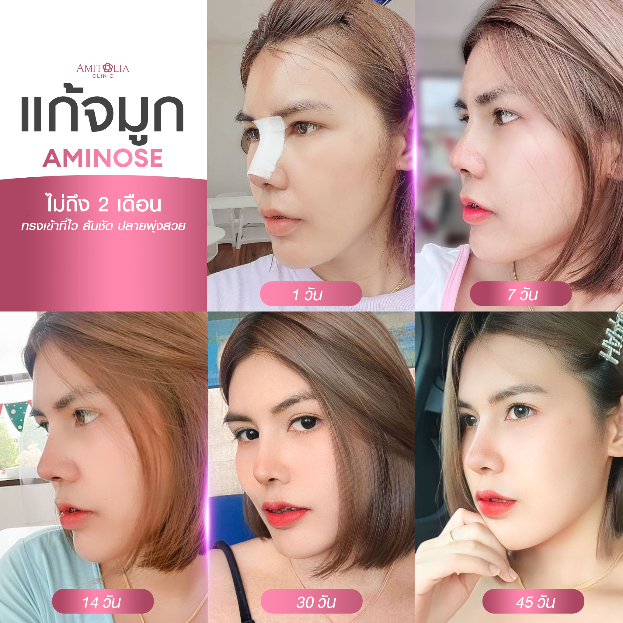 Review แก้จมูก #217
