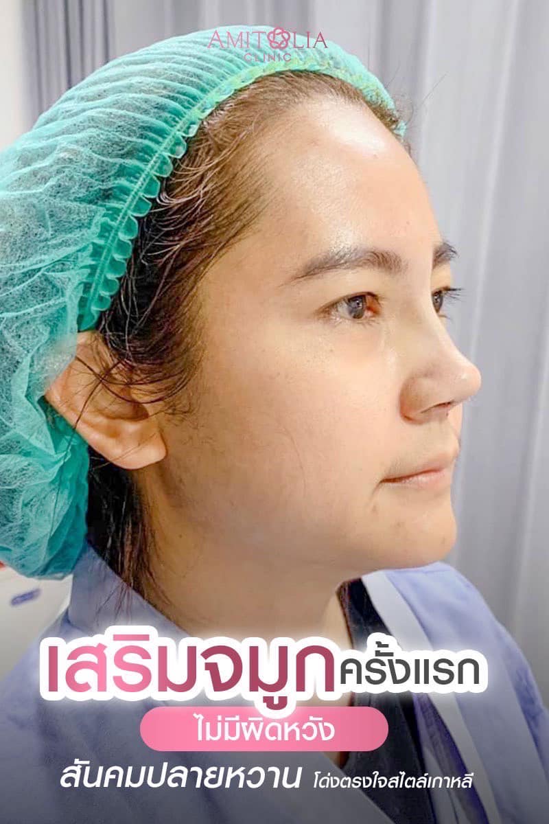 Review เสริมจมูก #224