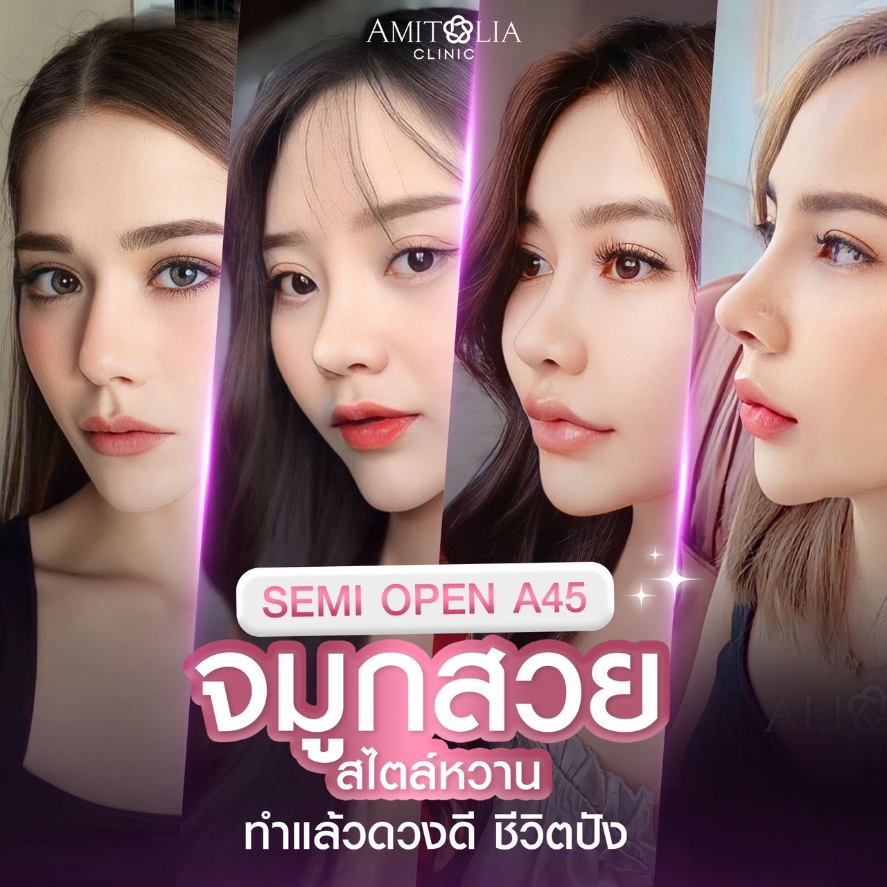 Review เสริมจมูก #227