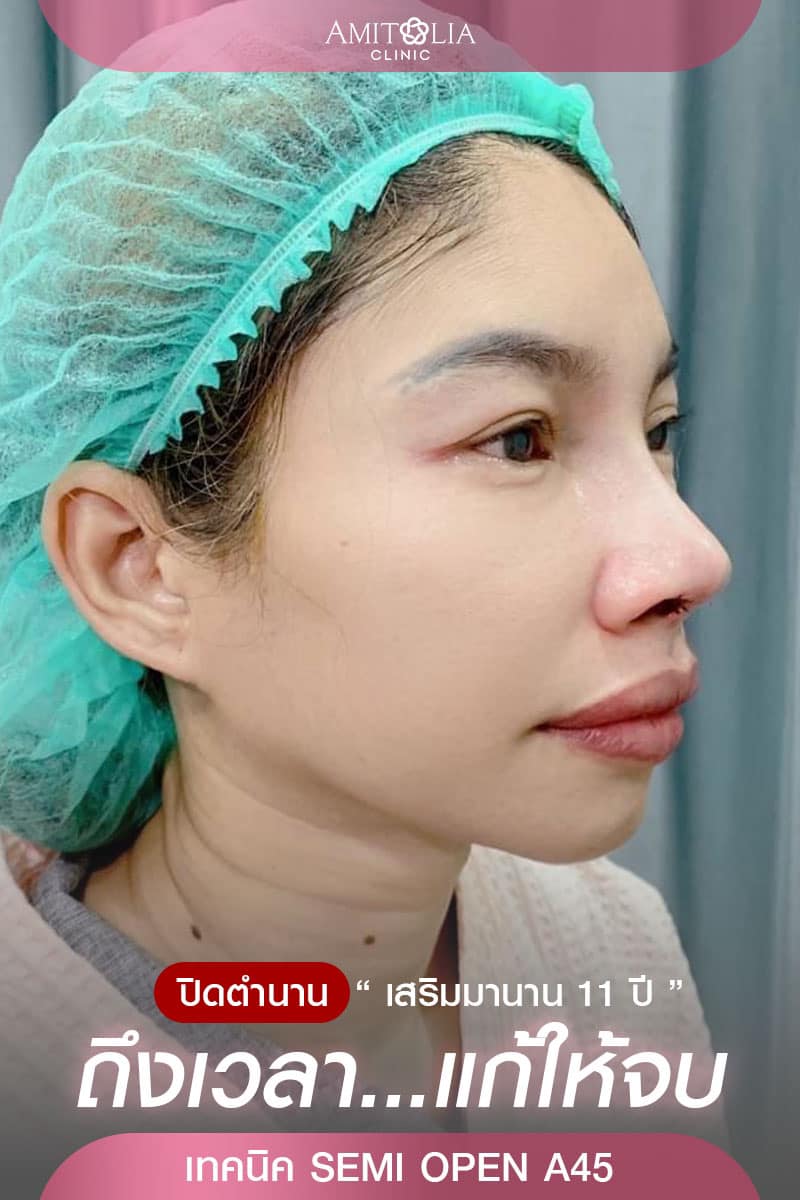Review แก้จมูก #228