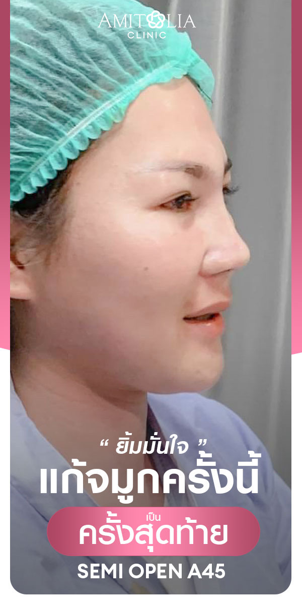 Review แก้จมูก #236