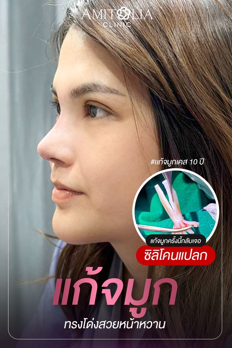 Review แก้จมูก #248