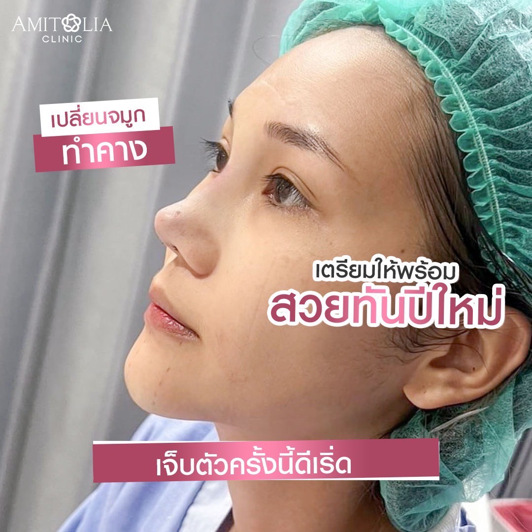 Review แก้จมูก #264