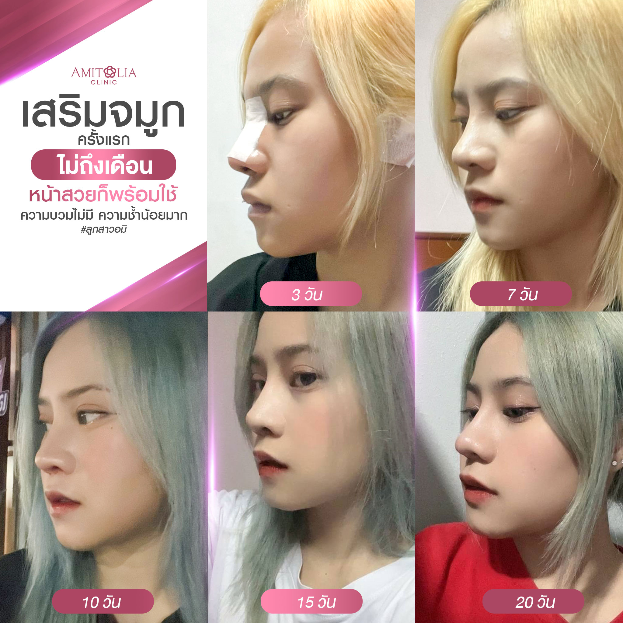 Review เสริมจมูก #278