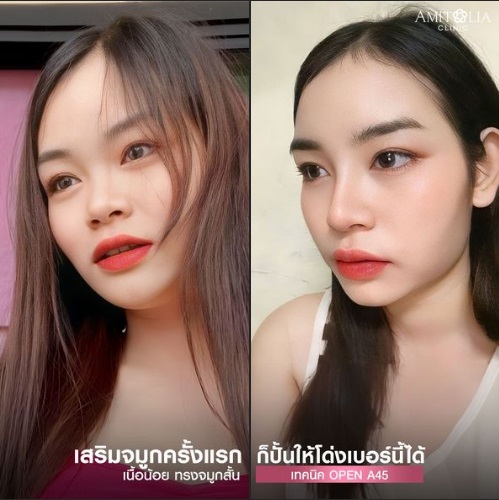 Review เสริมจมูก #282