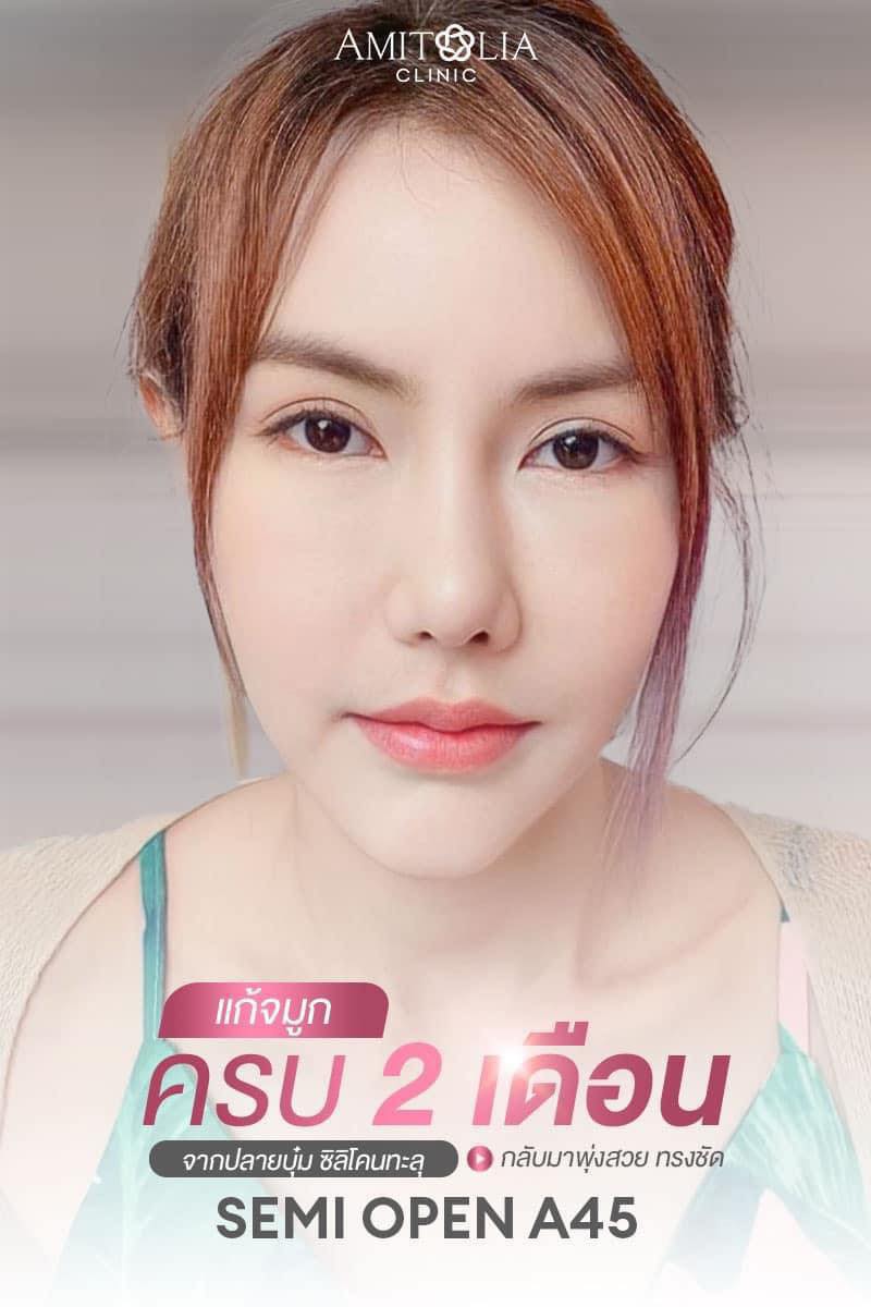 Review แก้จมูก #272