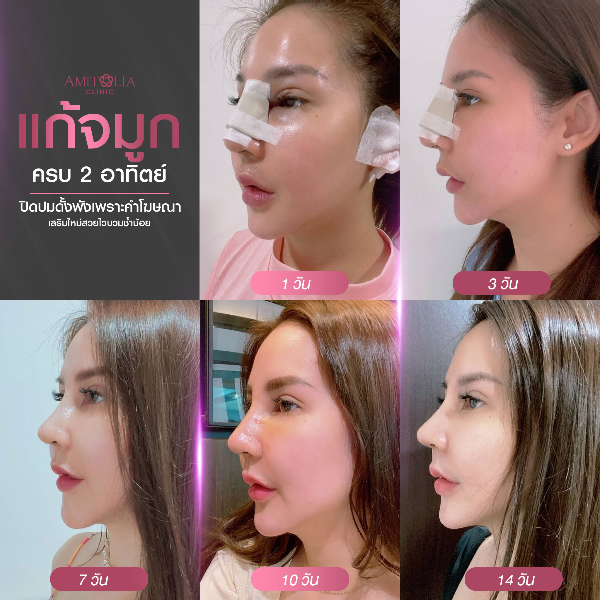 Review แก้จมูก #277