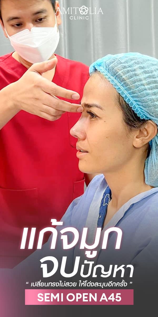 Review แก้จมูก #279