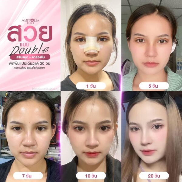 เสริมจมูก #295