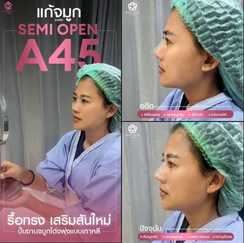 Review แก้จมูก #289