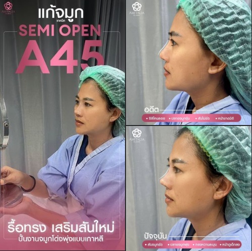 แก้จมูก 289