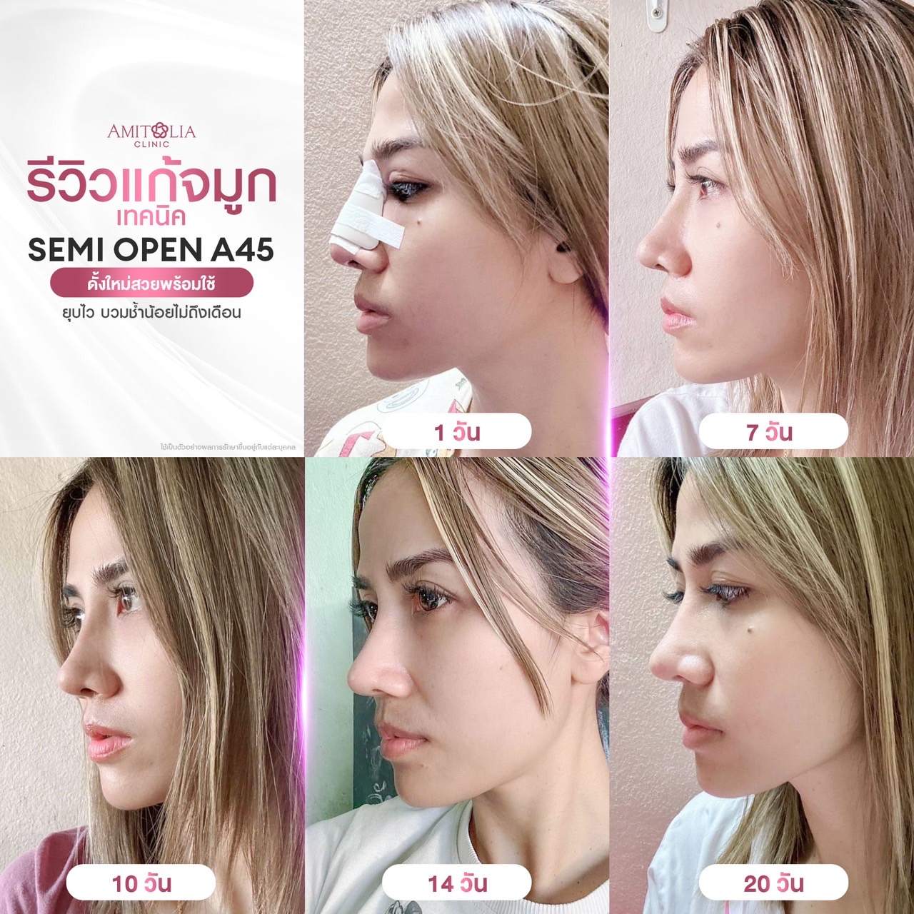 Review แก้จมูก #290