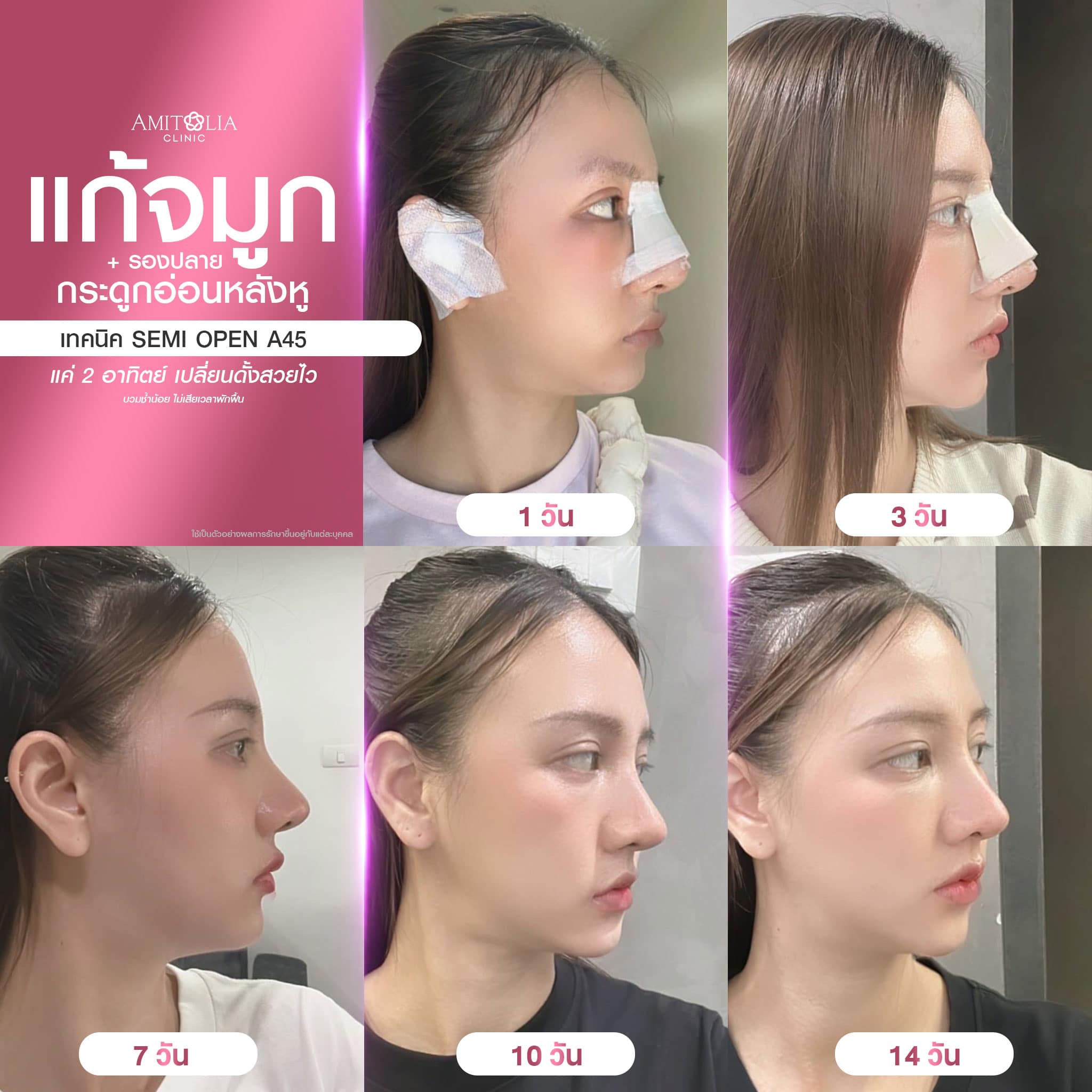 Review แก้จมูก #292