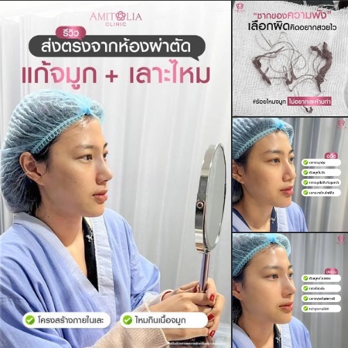 Review แก้จมูก #294