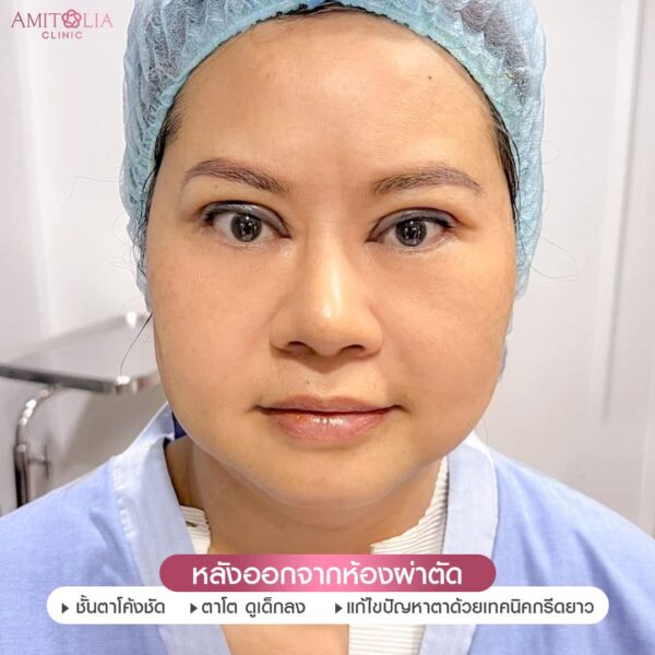 ตาสองชั้น #99