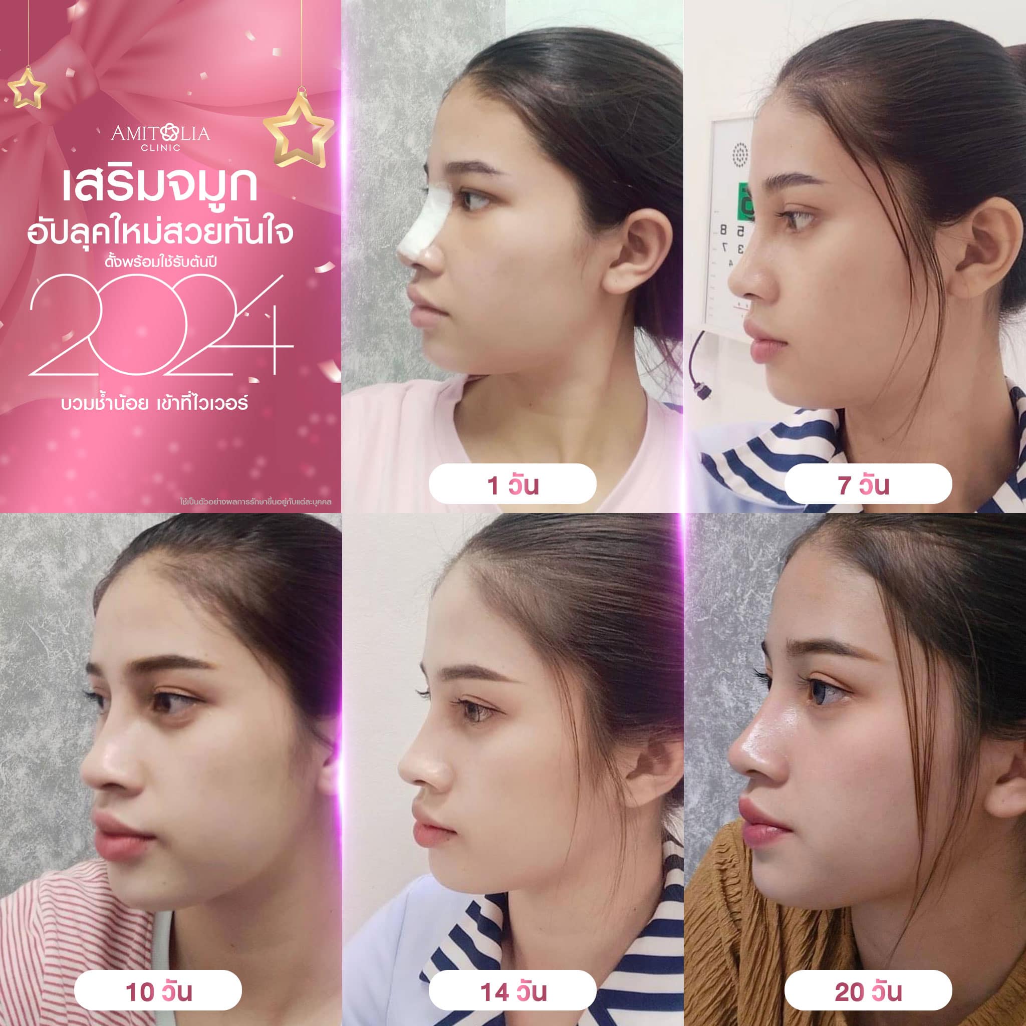 Review เสริมจมูก #300