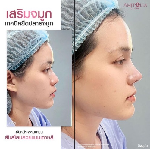 Review เสริมจมูก #307