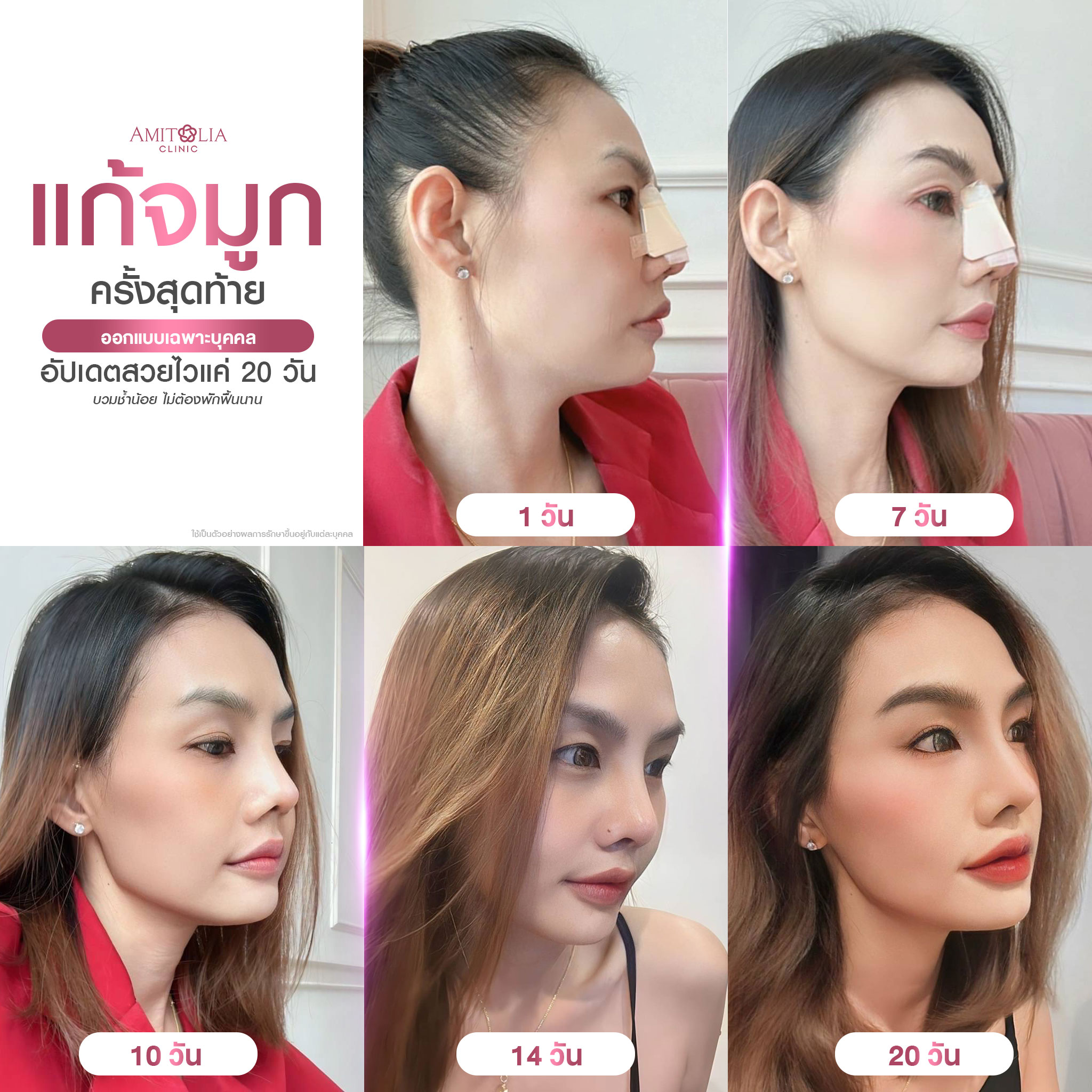 Review แก้จมูก #296