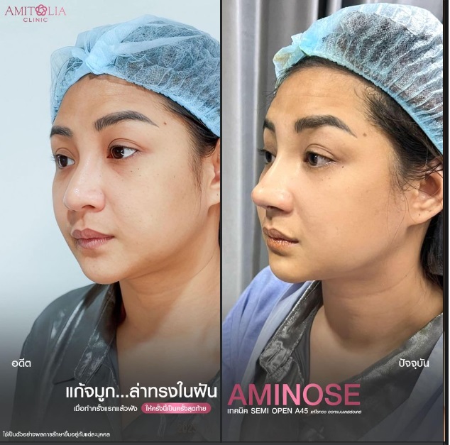 Review แก้จมูก #299