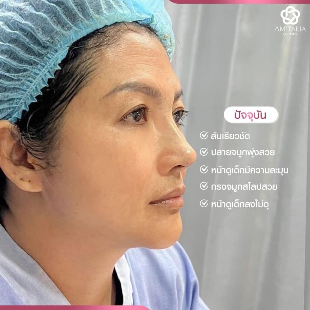 แก้จมูก #313