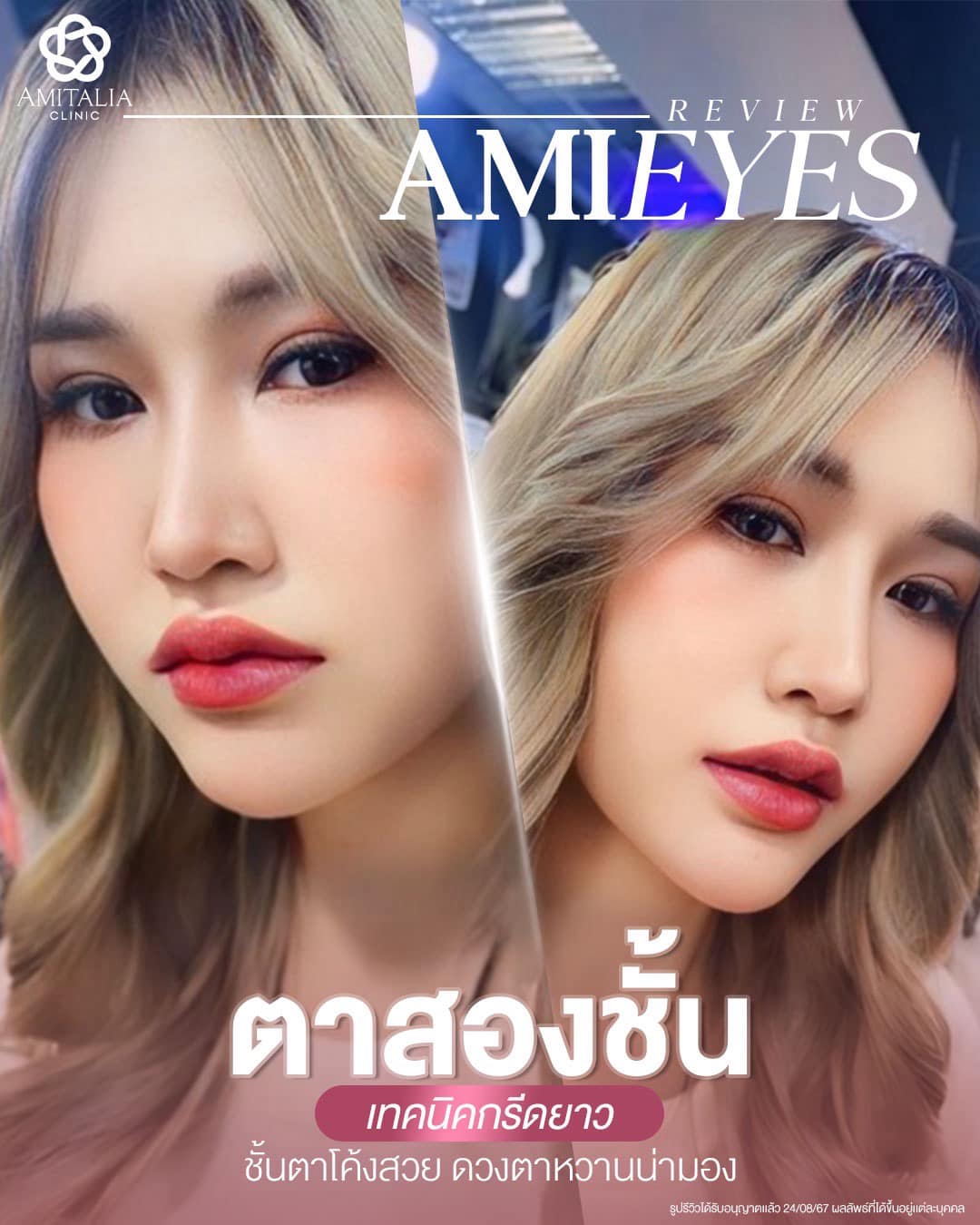 รีวิวหลังทำ ตาสองชั้น AMI EYES