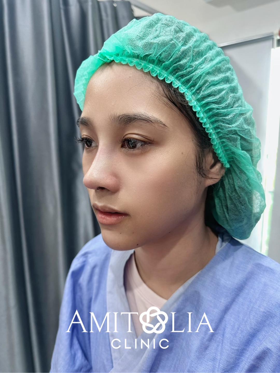 รีวิวแก้จมูกปลายสั้นเหิน