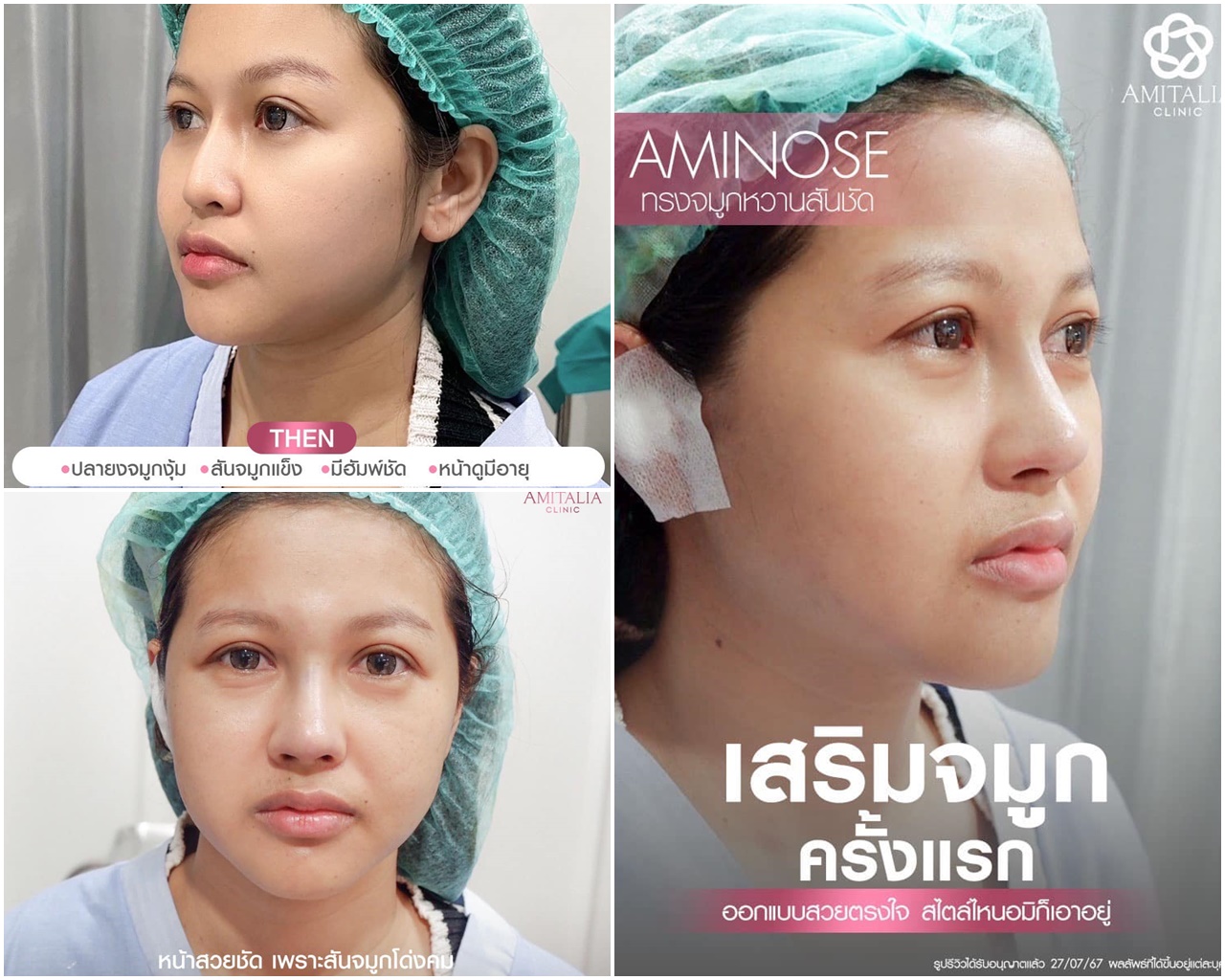 เสริมจมูกครั้งแรกก็เริ่ดขนาดนี้เลยหรอ?