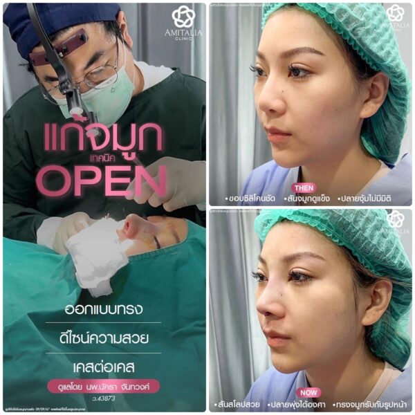 แก้จมูก