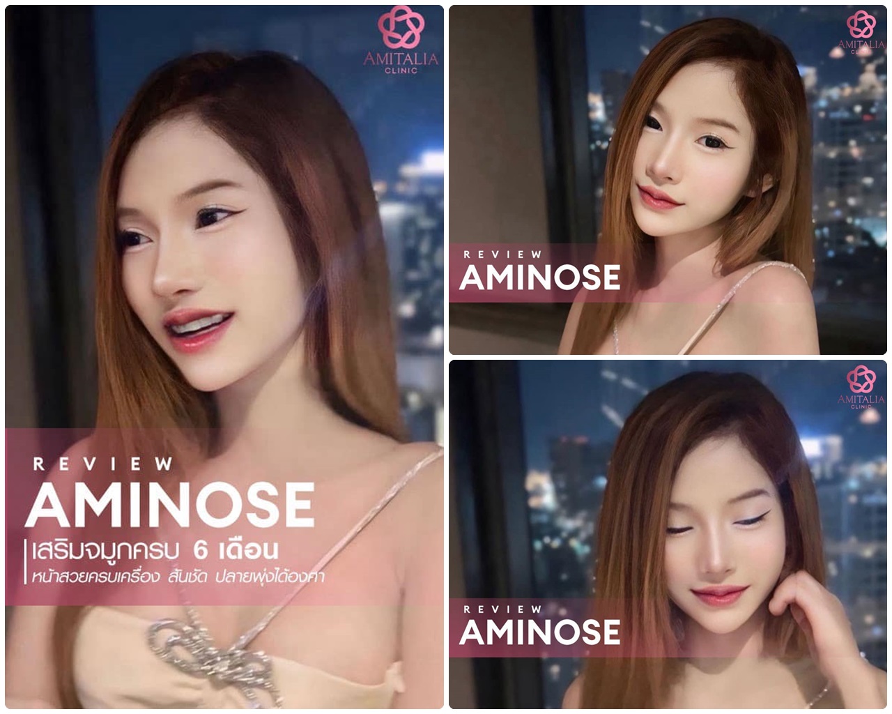 รีวิวจมูกครบ 6 เดือน!