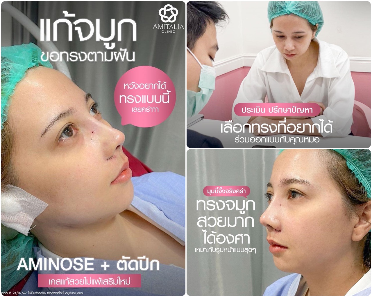 Review แก้จมูก+ตัดปีก หลังทำเสร็จทันที